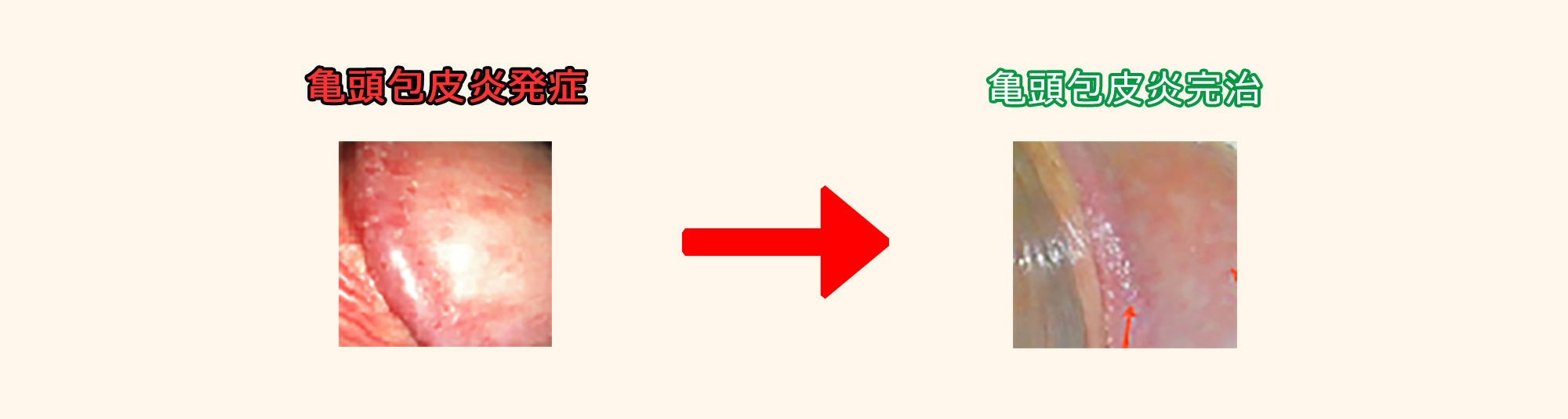 亀頭包皮炎 きとうほうひえん は市販薬でも治せます 画像あり
