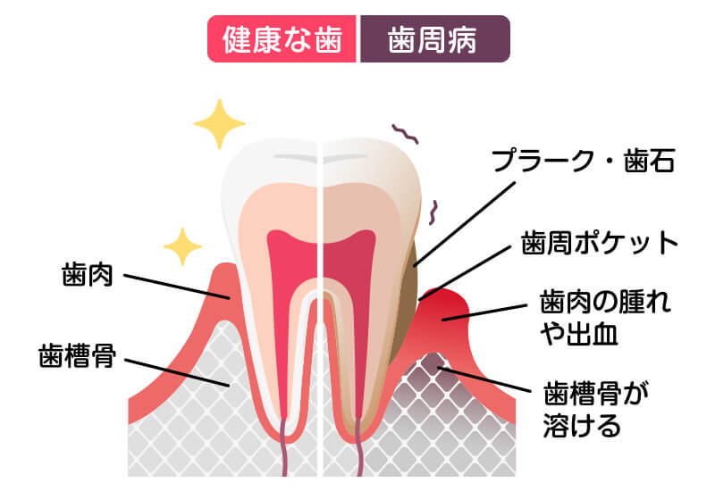 口の中には歯周病菌が増殖