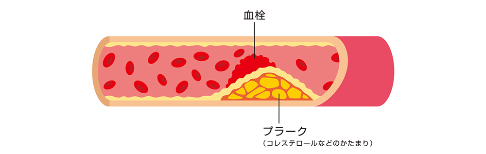 動脈硬化