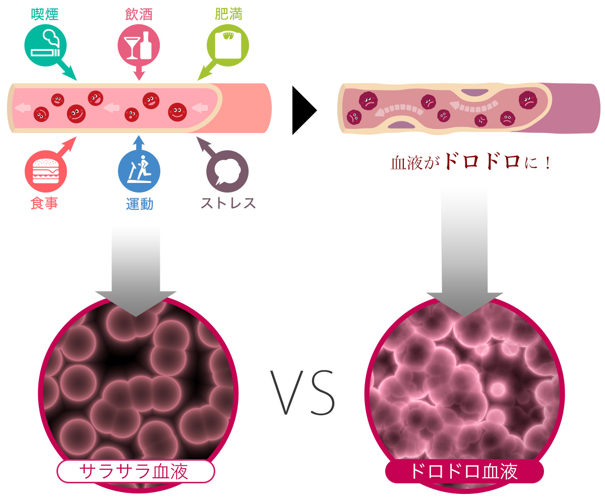 プラークが血管内に蓄積する生活習慣