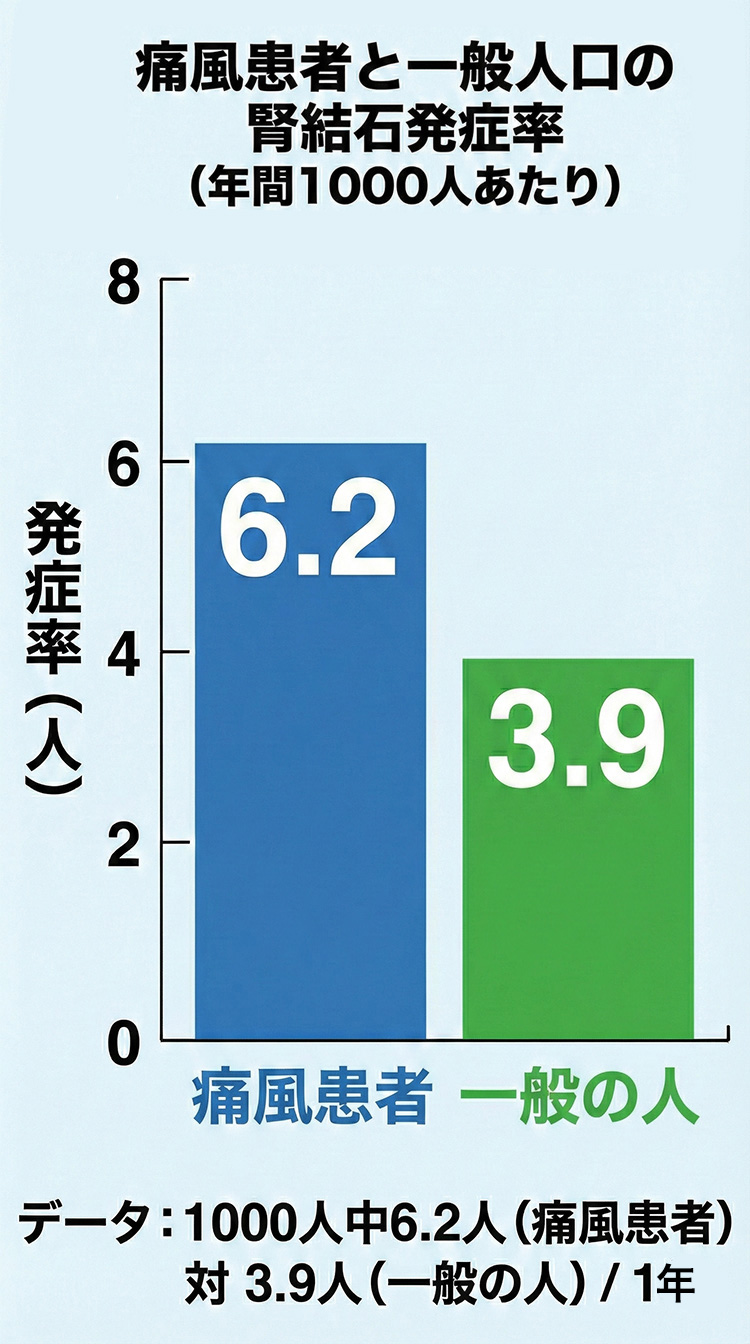 痛風患者の腎結石発症率1000人中6.2人 ／1年 一般の人では1000人中3.9人 ／1年