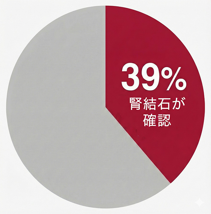 痛風患者の約39％に腎結石